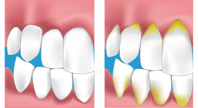 Dentiste Roubaix, soin des gencives