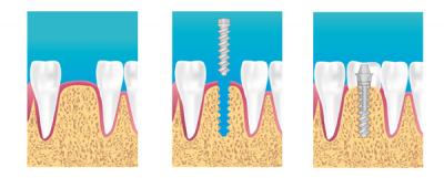 implantologie Dentiste Roubaix
